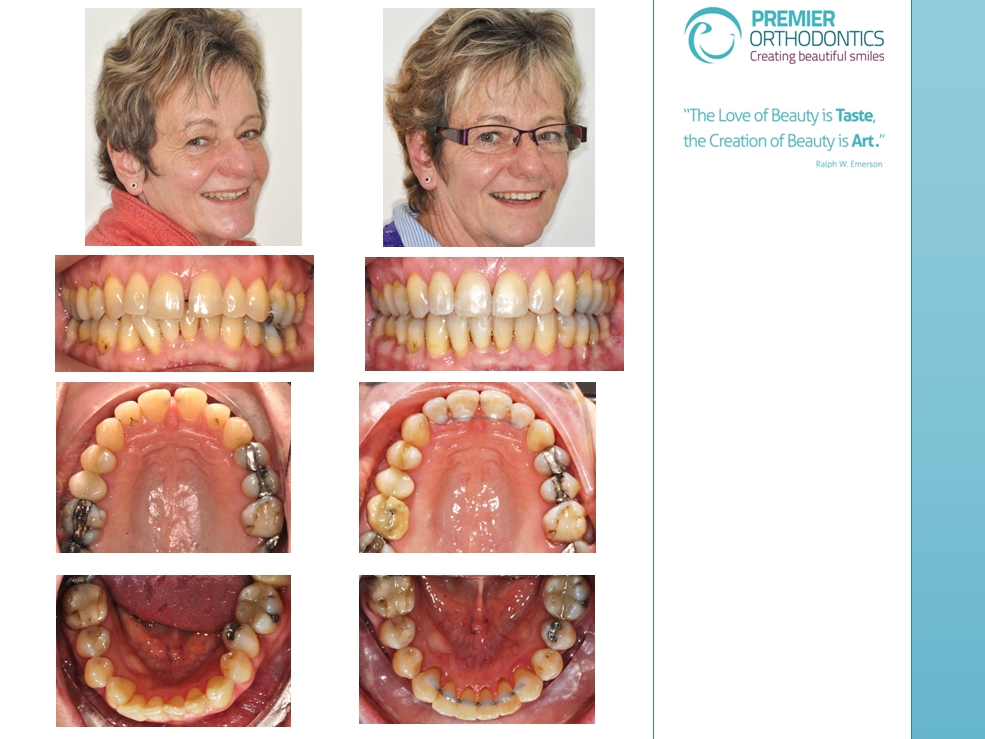 Bromley Kent Adult Orthodontist Before & After