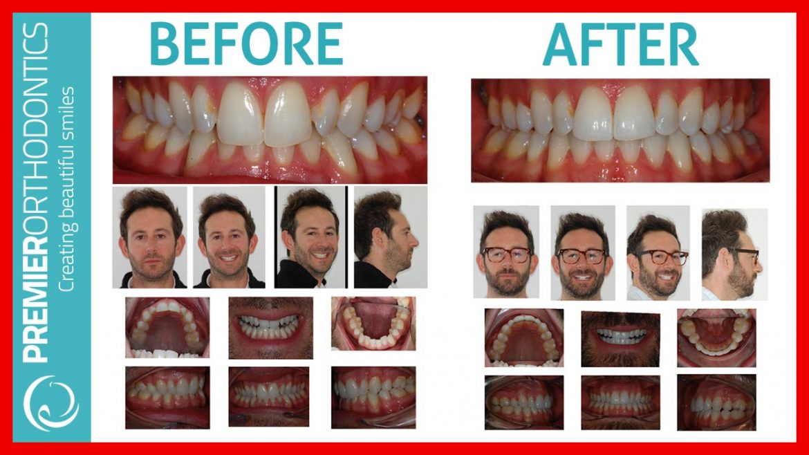 Best Invisalign South East London Review Before and After