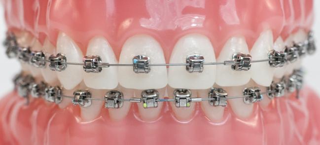  Metal  Damon  Braces Package Premier Orthodontics
