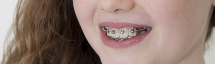 Living with Braces – Get Prepared!
