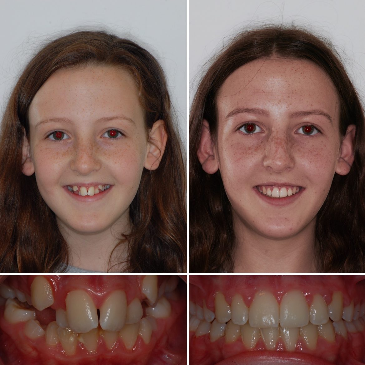 teeth brace before and after