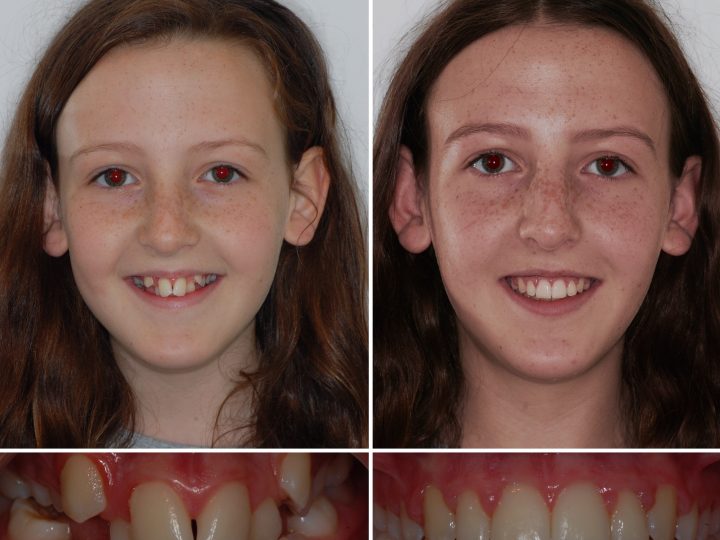 Get your braces fitted THIS summer!