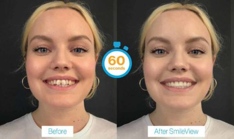 SmileView Smile & Straight Teeth Simulator Tool
